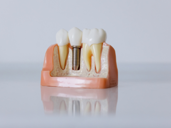 Dental Implants in Atlanta