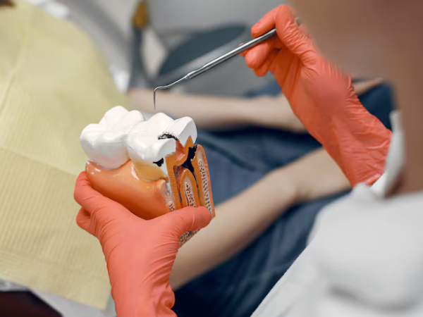 Root Canal in Atlanta